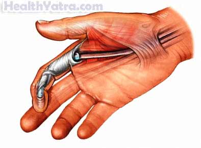 Name:  Finger-Flexor-Tendon-Injury.jpg
Views: 156
Size:  13.0 KB