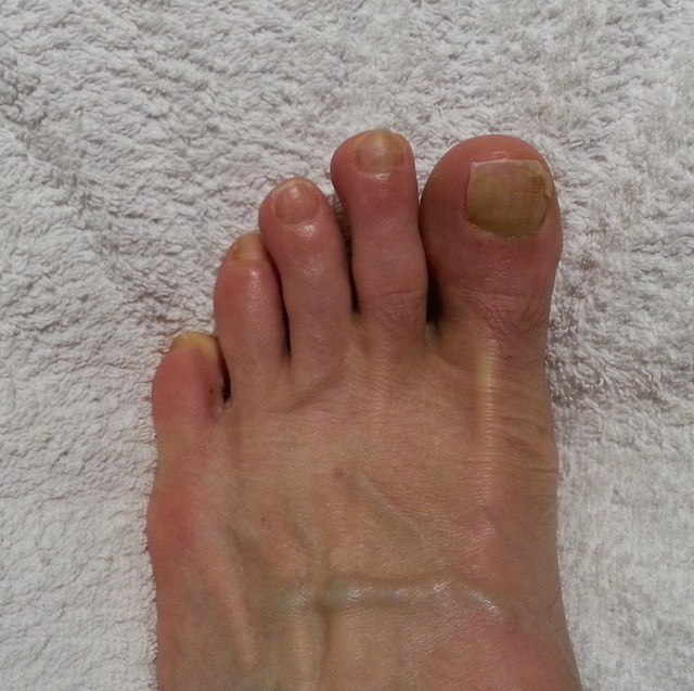 Name:  Trench foot toes 640.jpeg
Views: 778
Size:  185.3 KB